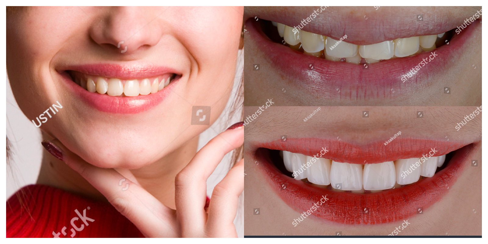 A female that had smile makeover, smiling