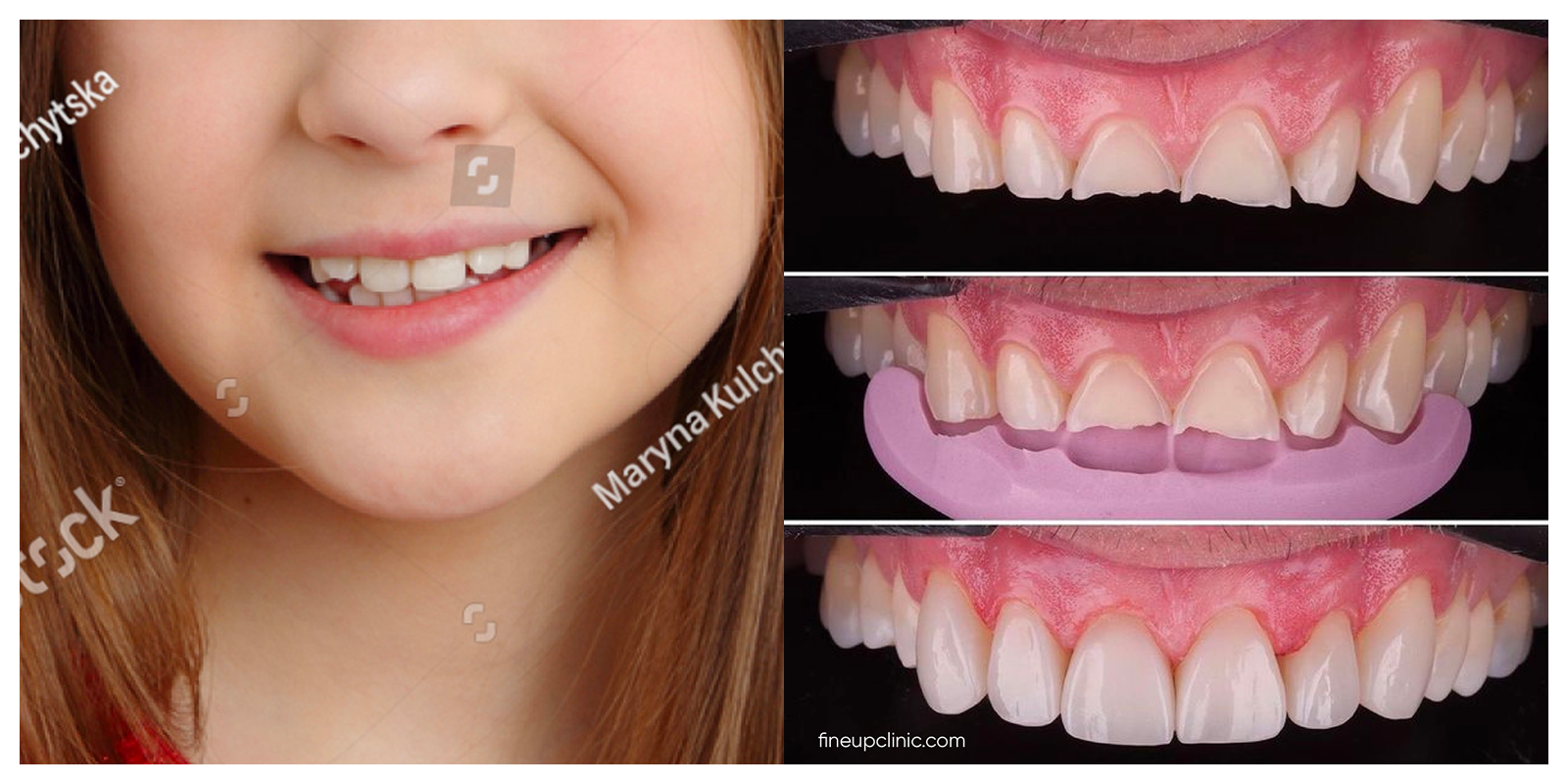 A kid that had a smile makeover, smiling