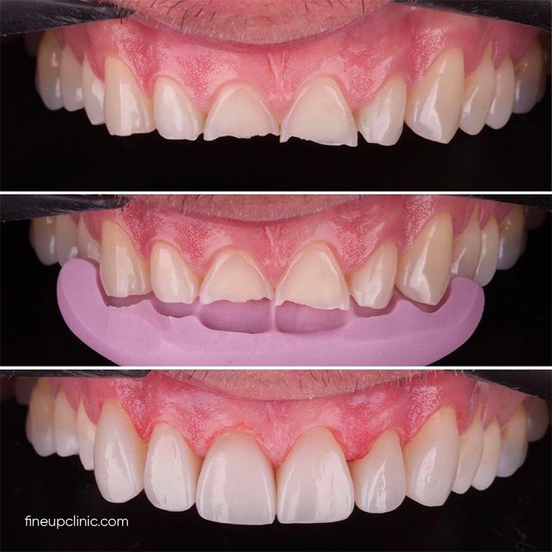 Restoration of short front teeth