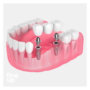 Fineup_Dental-implant_2