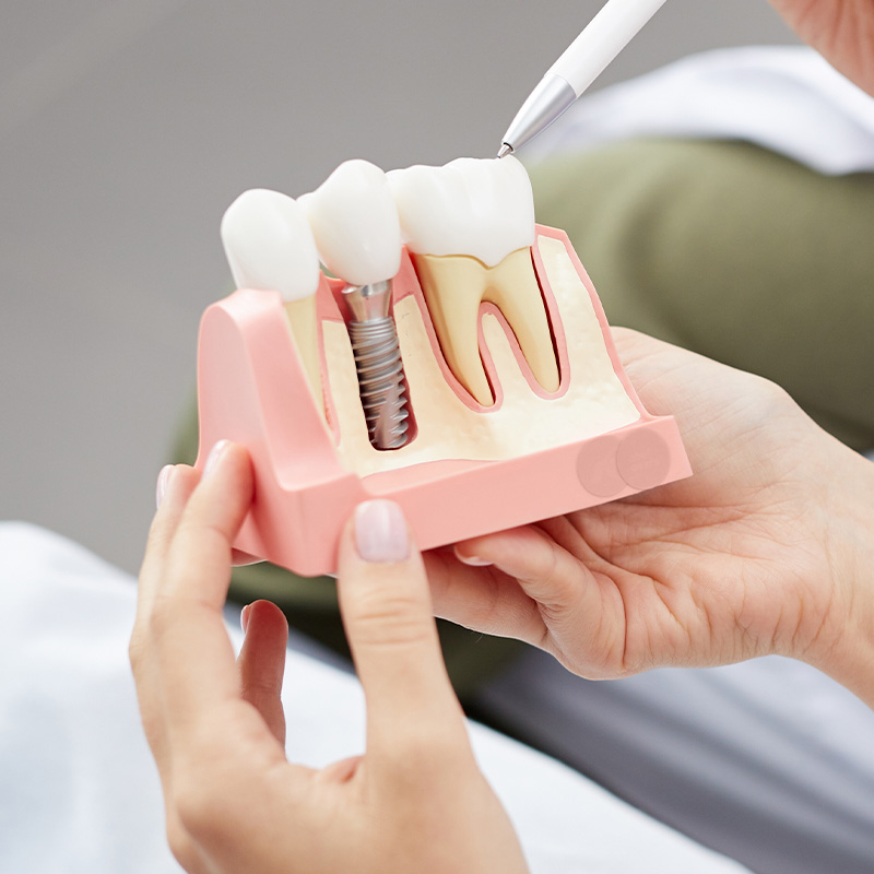 A model of dental teeth and dental implants