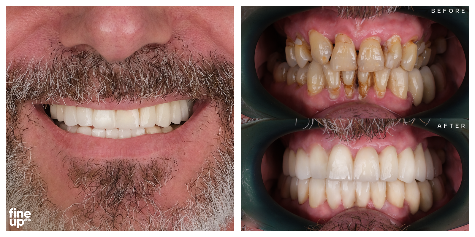 Male bearded man with a smile makeover