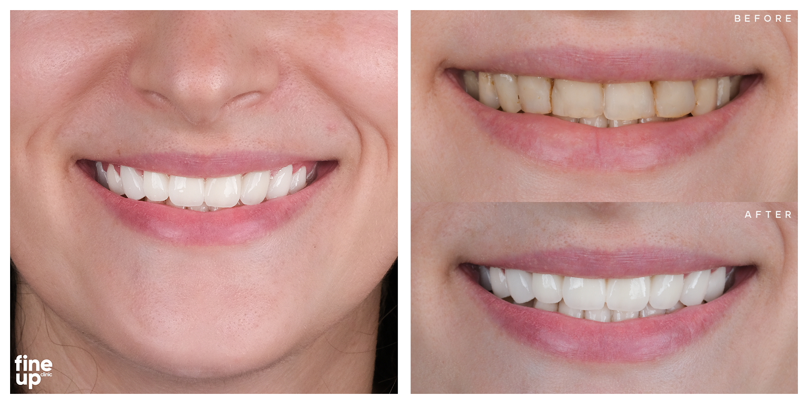 The mouth of a women that had a smile makeover