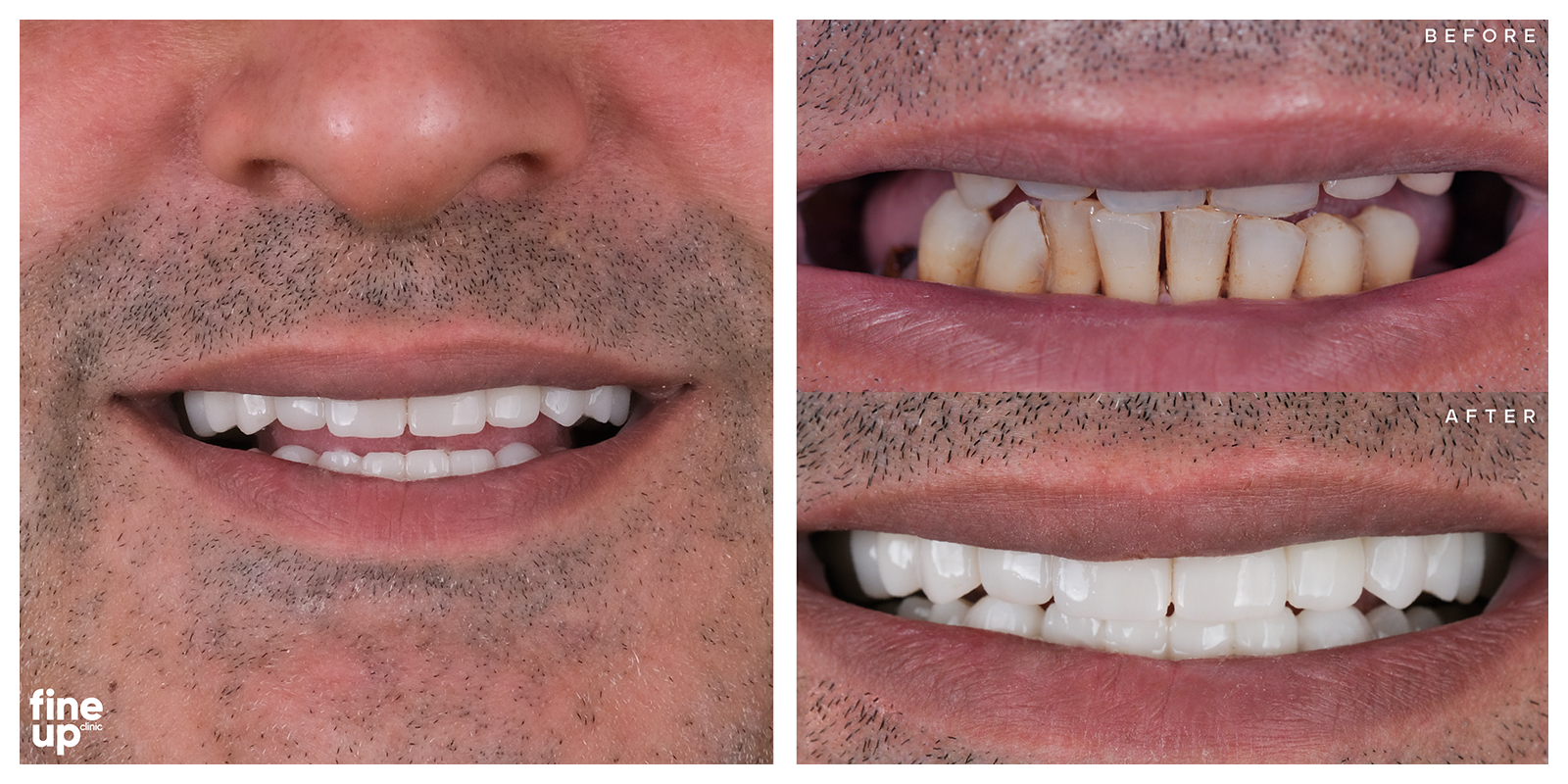 Before after images of a male patient that had a smile makeover