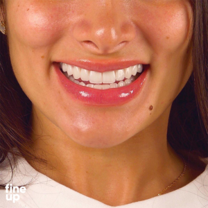 Woman patient with a smile makeover, upper and lower teeth