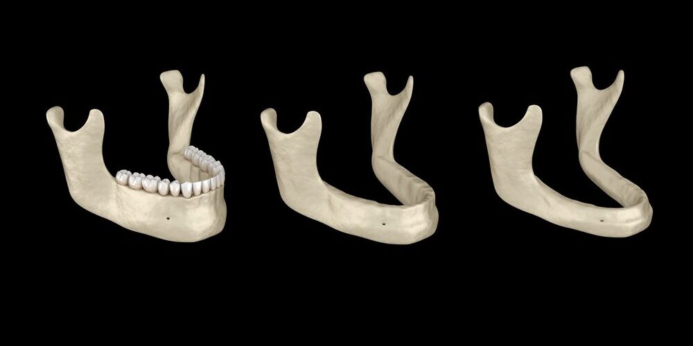 3 jaw bones with bone loss