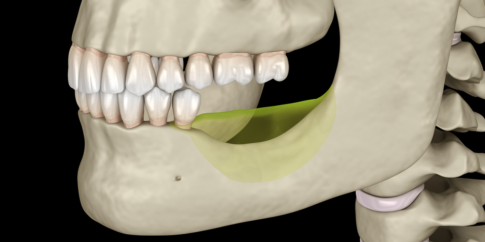 Jaw bone with a bone graft