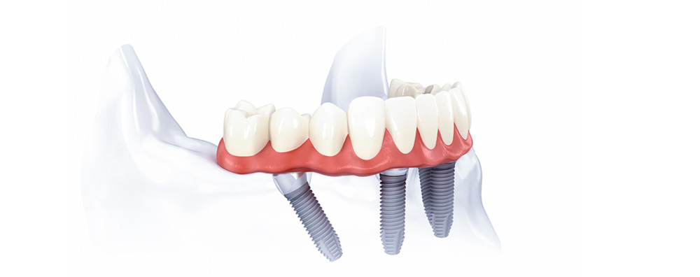 all on four implants shown in the lower jaw