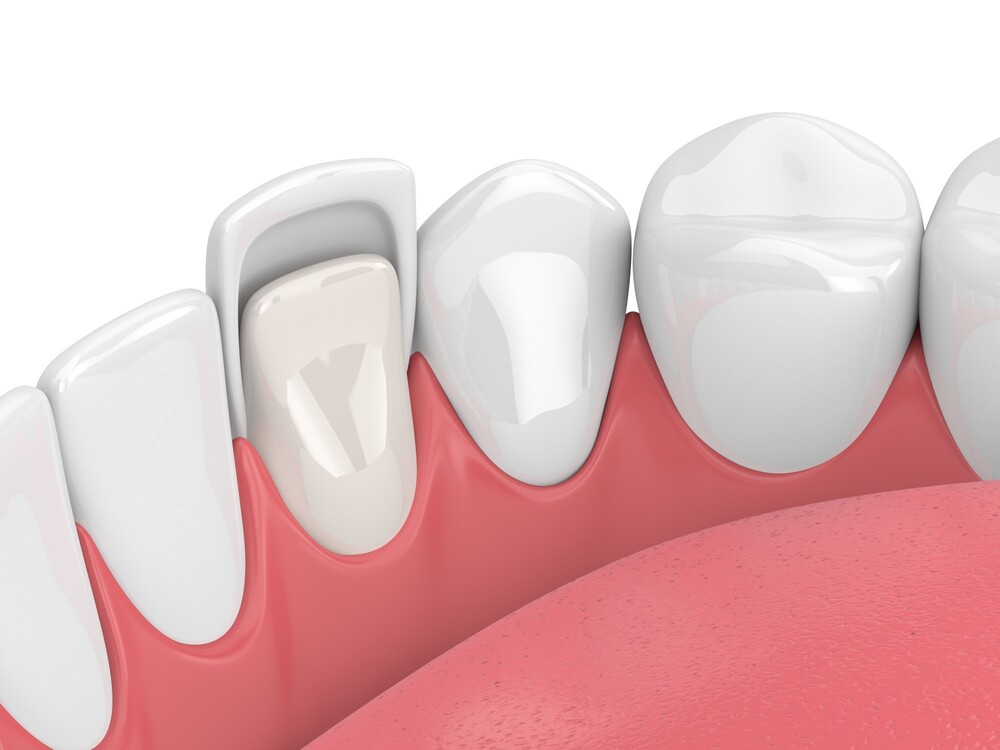 veneers rot teeth