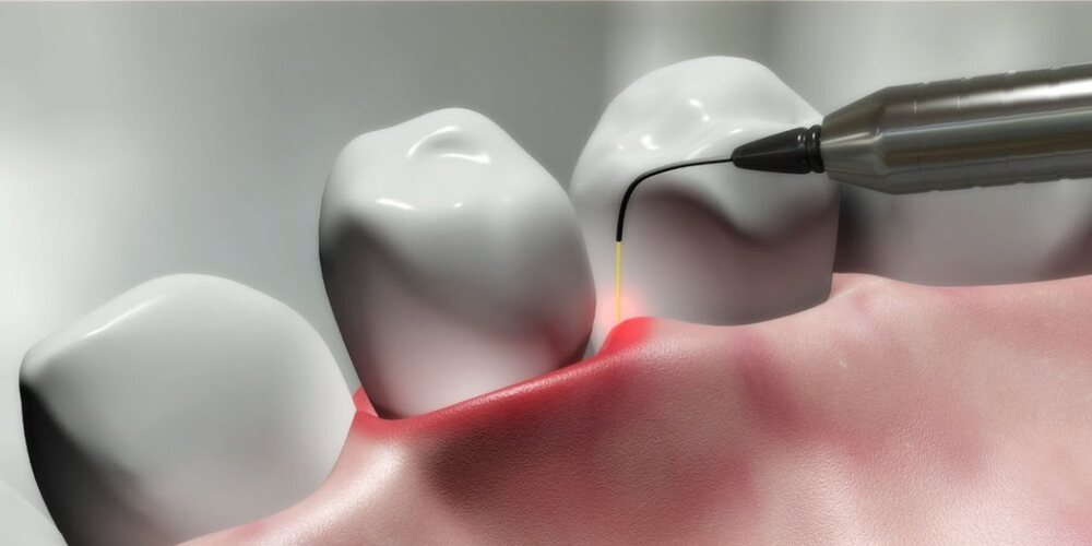 gummy smile treatment by laser