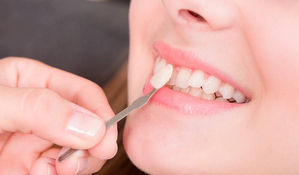 veneers getting placed