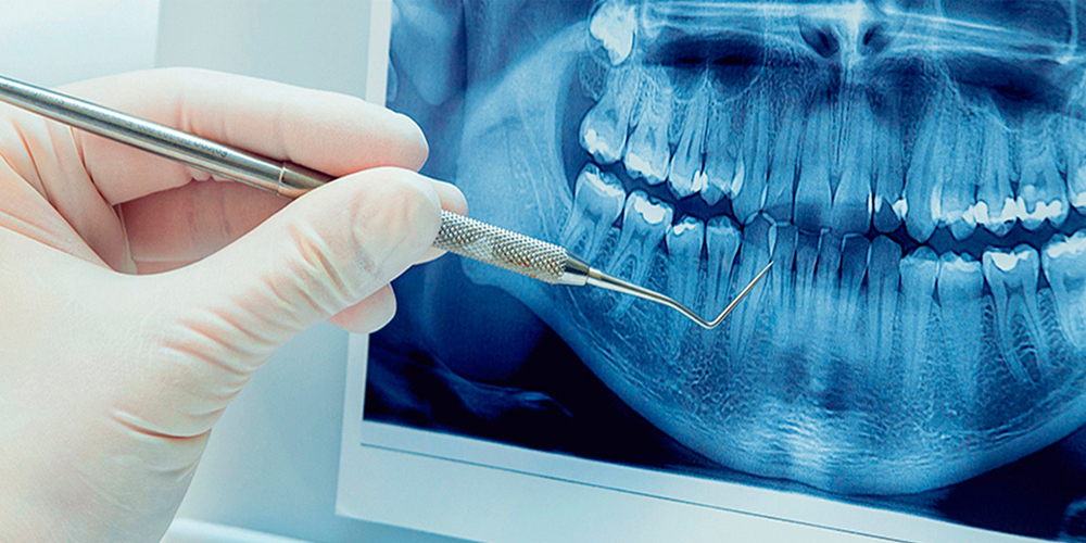 x-ray of a dental post