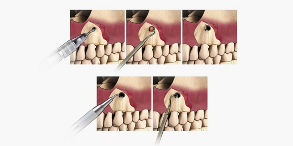 Apicoectomy process shown in panels